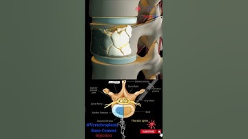 Bone Cement Injection - Vertebroplasty - Percutaneous Vertebral Augmentation - Spinal Cement