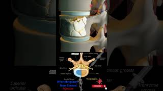Bone Cement Injection - Vertebroplasty - Percutaneous Vertebral Augmentation - Spinal Cement