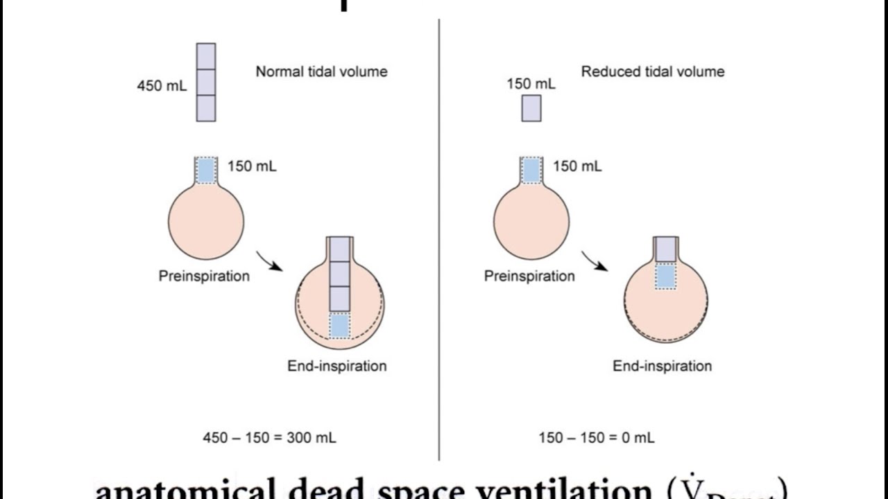 dead space in ventilator tubing