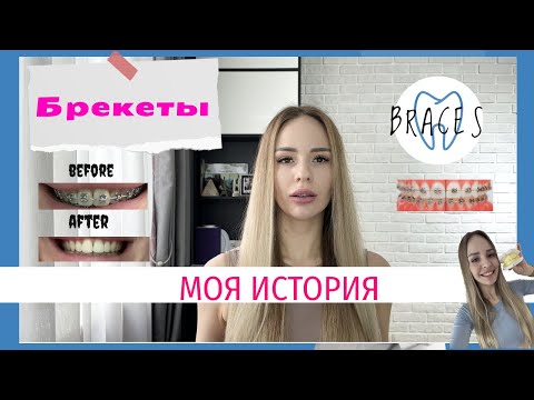 Видео: Брекеты. Моя ТРЕШ история. Много фото