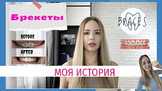 Брекеты. Моя ТРЕШ история. Много фото