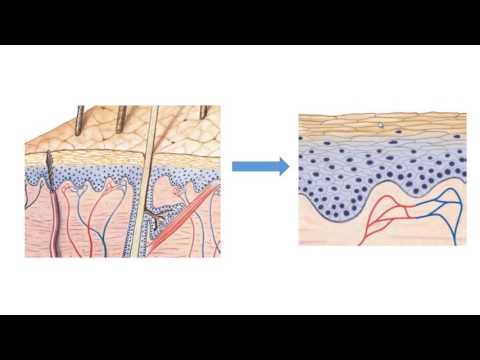 Video: Kwantitatieve Beoordeling Van Stralingsdosis En Fractioneringseffecten Op Normaal Weefsel Met Behulp Van Een Nieuw Longfibrose-indexmodel