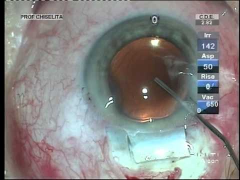 Video: Operație Sub Hipnoză - Vedere Alternativă