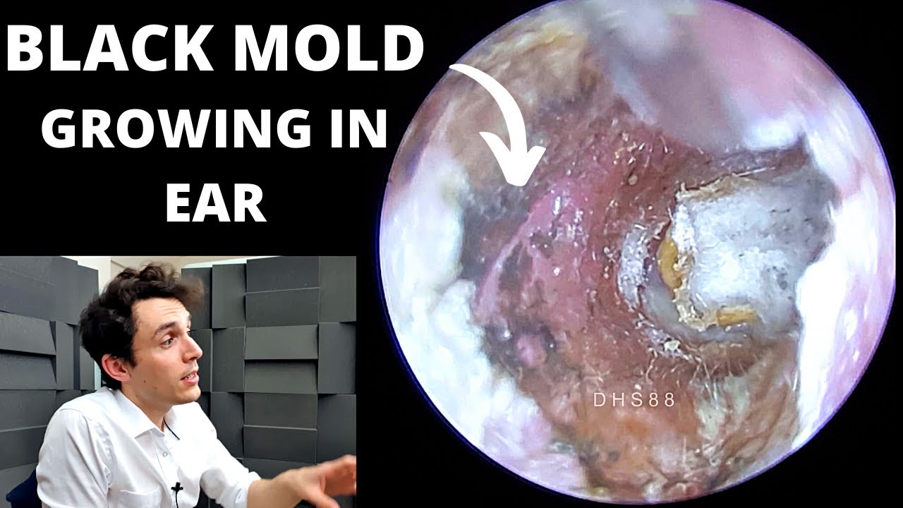 Black Mold Growing In Ear Canal (Aspergillus Niger Fungus Extraction