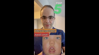 Adenoid hypetrophy 👦 تضخم اللحمية عند الأطفال