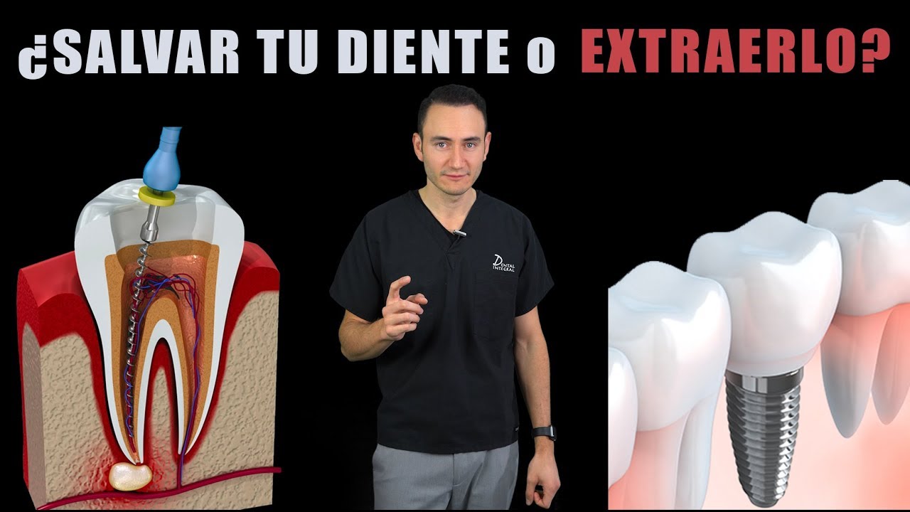 Cuanto cuesta endodoncia