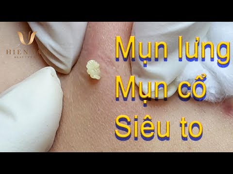 Cách điều trị mụn Lưng, Mụn cổ hiệu quả nhất TPHCM - bai 110