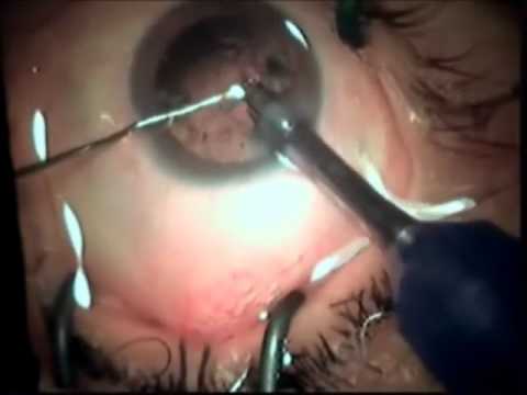 Dr. Hilal M Hilal Triple Procedure