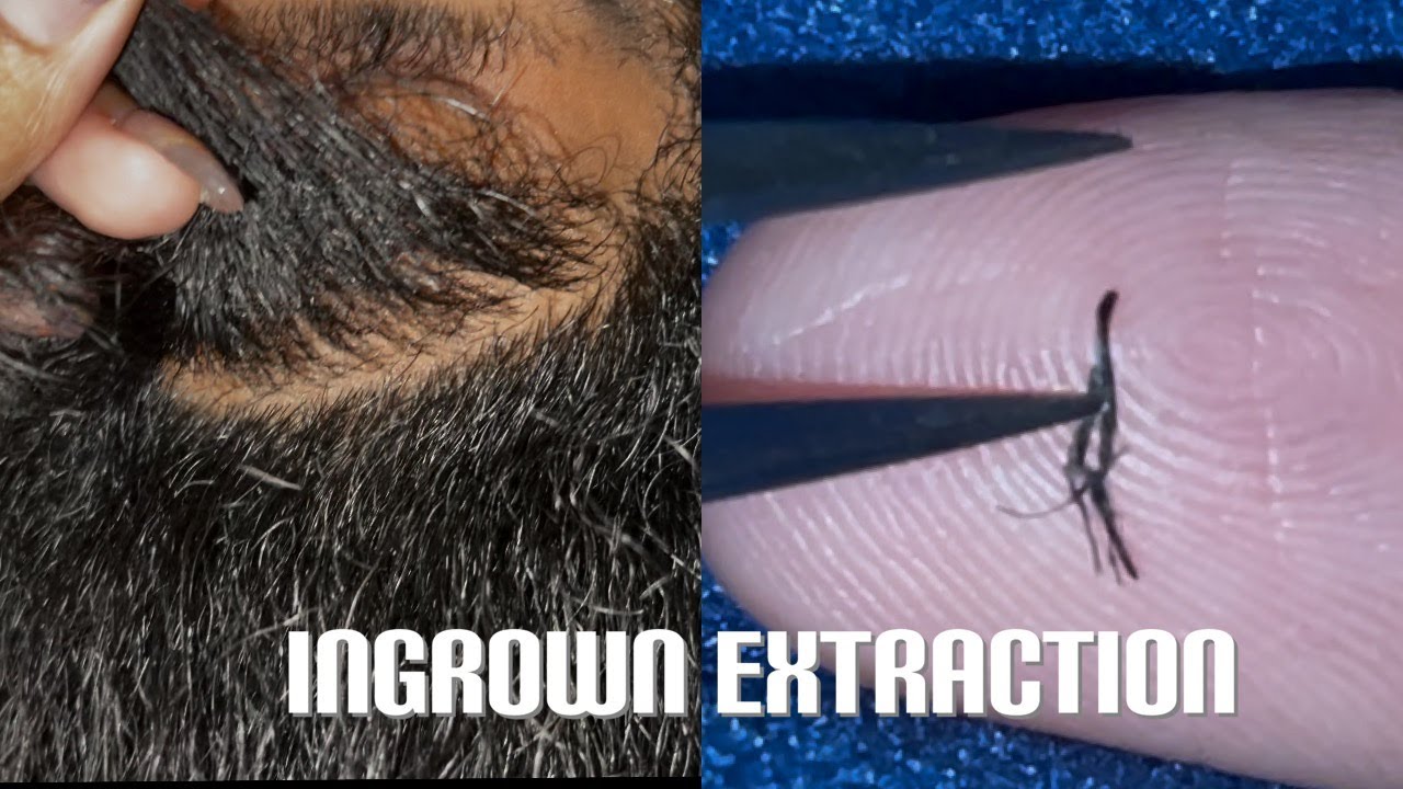 Super Satisfying Ingrown & Compound Hair Extraction From Beard!!! YouTube
