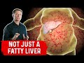 A Fatty Liver Spreads to all Your Organs