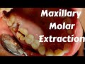 Maxillary Molar Extraction By Split & Section Technique & Complication || Exodontia Lecture