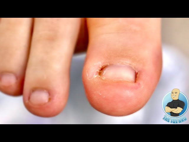 What Causes Ingrown Toenails?: The Foot & Ankle Specialists: Podiatric  Medicine