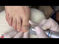 Fungal Nail with Dried Abscess 🦶 Ingrown Nail Treatment 🦶 Thick Fungal Toenail Podiatry #02