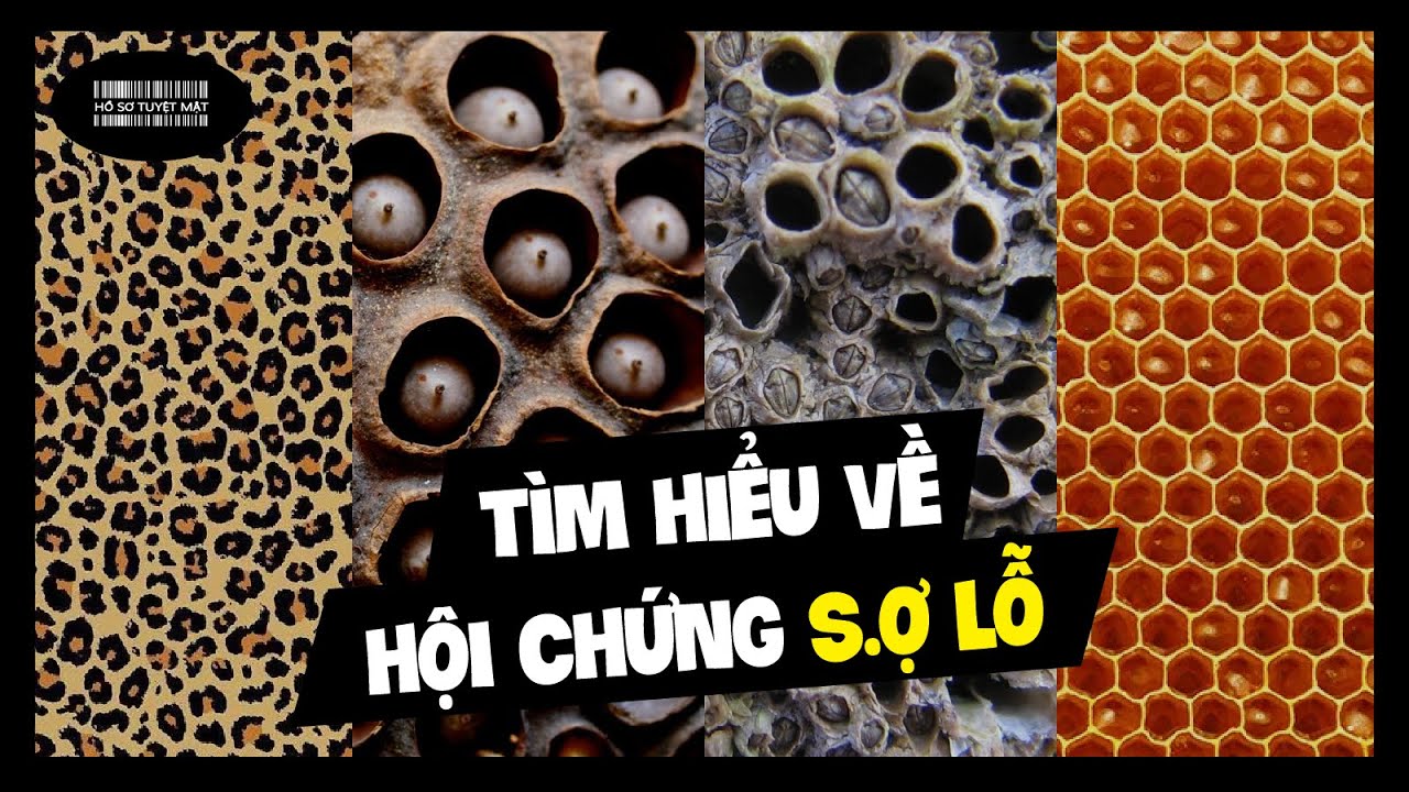 Trypophobia Chứng Sợ Lỗ Là Gì Giải Thích Chi Tiết Trong 3 Phút 