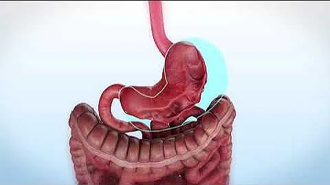 ESG Animation, Grand Strand Bariatric Surgery