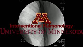 Transbronchial Forcep Biopsy with SuperDimension