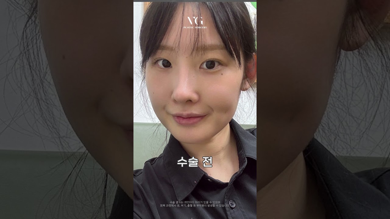 [莓好整形外科診所] 做了輪廓變Karina了