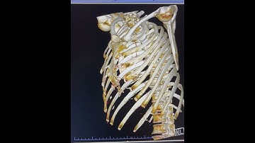 CT-3D Thorax #medicalimaging #ct #medicalequipment #anatomy