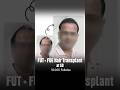 Age 50, New Confidence | 10,000 Follicles Hair Transplant