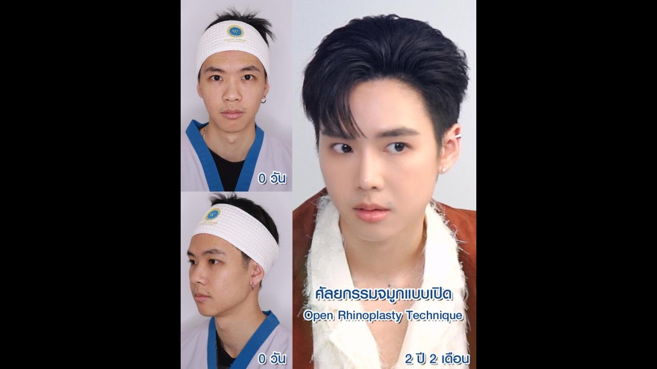 คุณกาน✨ เสริมจมูกด้วยเทคนิค Open Rhinoplasty  ที่  𝐖 𝐇𝐨𝐬𝐩𝐢𝐭𝐚𝐥‼