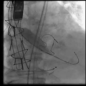 BAV of the Aortic Valve Showing the Watermelon Seeding of the Balloon