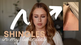 My Shingles Experience (in my 20&#39;s) | Rutele