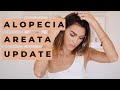 COMO ME CRECIO CABELLO?- ALOPECIA AREATA UPDATE-@karelytips