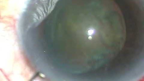 The  LTT (Lens Tilt Technique) for soft cataract by P Mohanta (NEH, 14/11/2016)