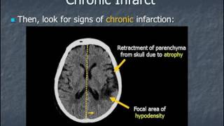 AN APPROACH TO CT HEAD  NARRATED 2