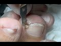 Pedicure tutorial big nail under toe corner feel so much relief