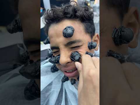 ازالة الحباية المتسلطنة من الخد       