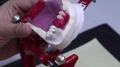 Lab # 5 : Part 2: Posterior Teeth Setting I Removable Partial Denture