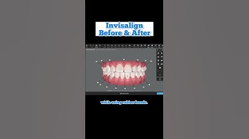 Behind the scenes: How we design teeth straightening with Invisalign for personalized treatment.