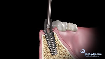 Restoration with a Rosetta Universal Scan Body Component
