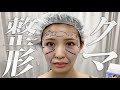 整形しました。ダウンタイム全部見せます。【クマ取り・脂肪注入】