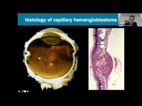 RareConnect.org Webinar: Diagnosis and treatment of retinal angiomas in VHL