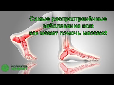 Отеки ног: причины, виды, диагностика, лечение, профилактика, советы. Какие осложнения возникают при отеках ног Мочегонные, народные средства, мази, упражнения при отеках ног: правила по применению