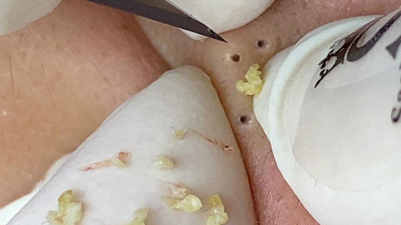 Don’t even think of skipping this large pimple popping scene