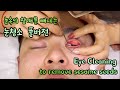 The fullversion of Cleaning my eyes to remove sesame seeds from my eyes/눈속의 참깨를 빼내는 눈청소 풀버전