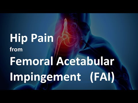 Hip Pain from Femoral Acetabular Impingement (FAI) - What is it and how to treat it?