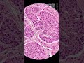 Liver Cirrhosis 20260314 1051 | Histopathology | Microscopic - Vertical Stock Footage