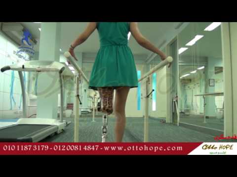 احدث طرف صناعى فوق الركبة هيدروليك شركة اوتوهوب  ت 01011873179 01200814847