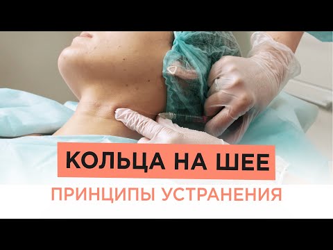 Как убрать КОЛЬЦА НА ШЕЕ? Разбираем варианты процедур