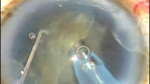 Modified Soft Shell Technique (MSST) and Phaco of a Hard cataract