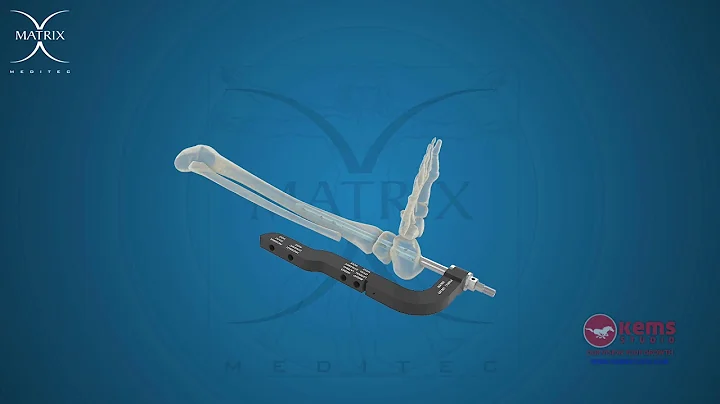 Ankle Arthrodesis Nail Surgical Technique 3D Animation