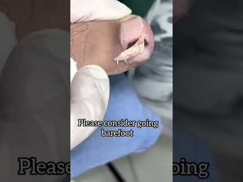 Why you should walk barefoot ep 21 | in-grown toe nails #shorts