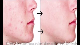 How to Remove Acne in Photoshop