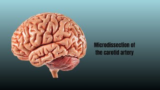 Microdissection of the carotid artery