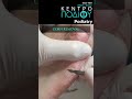 Corn Removal|Αφαίρεση Τύλου|Κέντρο Ποδιού Podiatry|Podiatrist|Podologos|Ποδίατρος|Podologia|Ποδολόγο