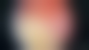 TÁN SỎI THẬN ĐƯỜNG HẦM QUA DA, 1/7/2019, TTUT.TS.BS.Duong Văn Trung☎0913534343.web:soithan.net.vn